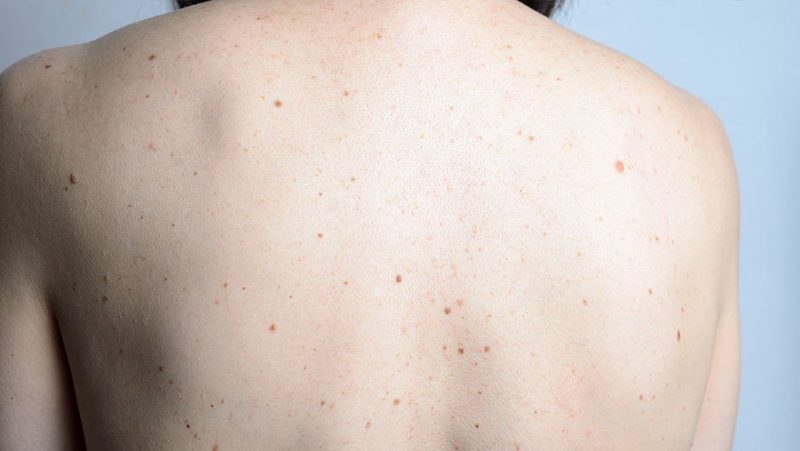 Всё, что вы хотели знать о родинках. Изображение номер 11 Всё, что вы хотели знать о родинках. Изображение номер 11