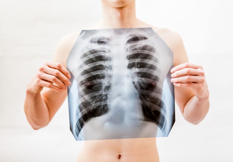 Признаки воспаления лёгких: что делать при пневмонии и когда идти к врачу. Изображение номер 1