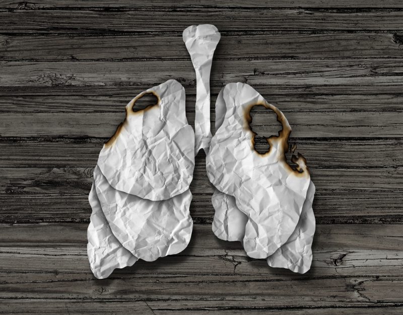 Признаки воспаления лёгких: что делать при пневмонии и когда идти к врачу. Изображение номер 4