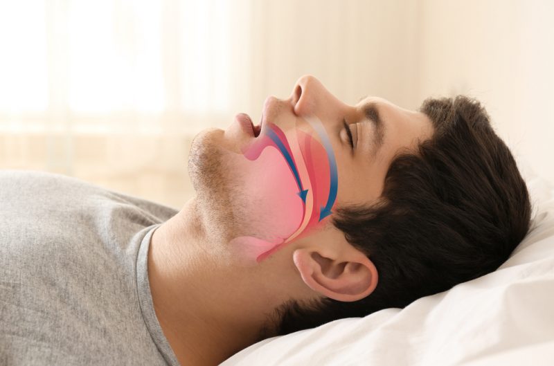 Остановка дыхания во сне: чем опасно апноэ и как его лечить. Изображение номер 1