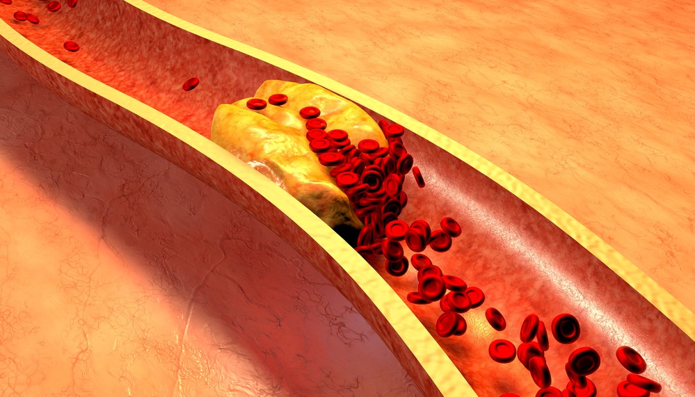 Всё о холестерине: какие показатели считать нормой и как снизить уровень холестерина в крови. Изображение номер 1