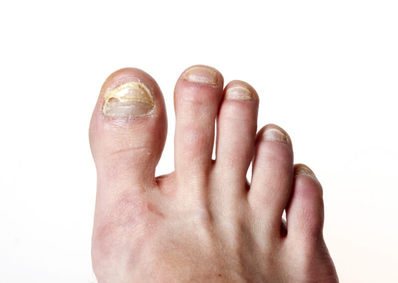 Грибок ногтей на ногах: причины, симптомы и лечение. Изображение номер 4