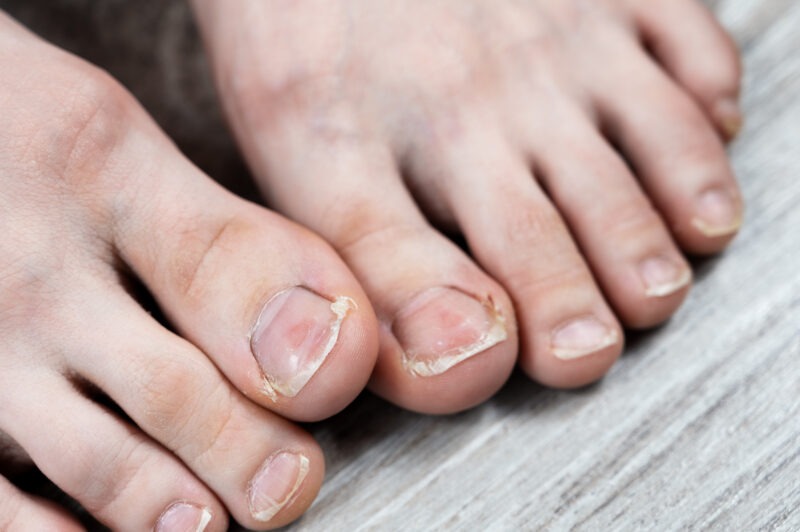 Грибок ногтей на ногах: причины, симптомы и лечение. Изображение номер 3